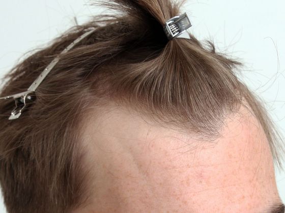 Hair Transplant - Male: Hairline FUE - Case 11 - Before FUE hair transplant