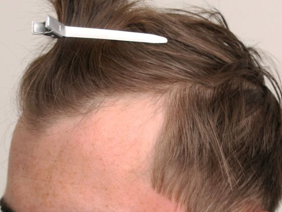 Hair Transplant - Male: Hairline FUE - Case 11 - Before FUE hair transplant