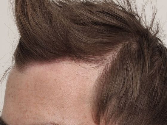 Hair Transplant - Male: Hairline FUE - Case 11 - After FUE hair transplant