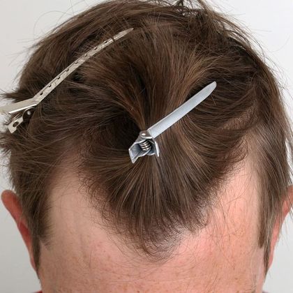 Hair Transplant - Male: Hairline FUE - Case 11 - Before FUE hair transplant