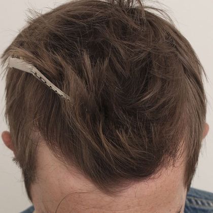 Hair Transplant - Male: Hairline FUE - Case 11 - After FUE hair transplant