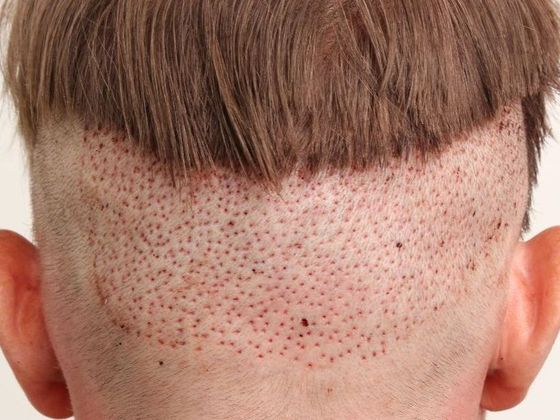 Hair Transplant - Male: Hairline FUE - Case 11 - Post-op FUE hair transplant