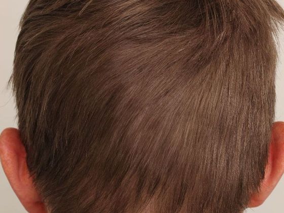 Hair Transplant - Male: Hairline FUE - Case 11 - Donor area after FUE