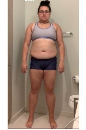  Patient Transformation Stories Natalie 10 Weeks Post-Op! - Before