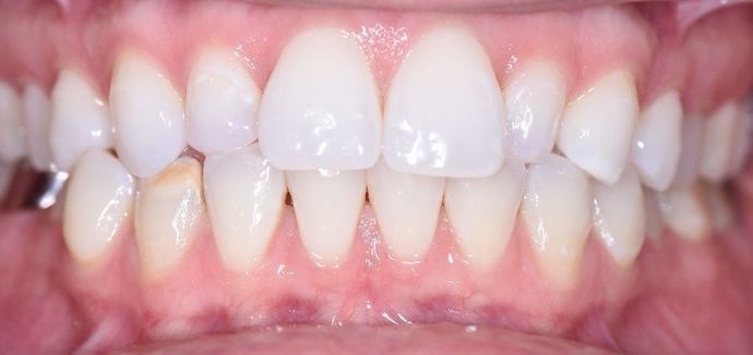 Tooth-colored Fillings Case 13 - Edna, TX - Before