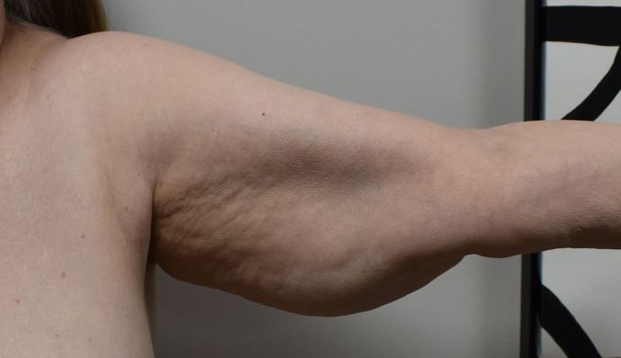Brachioplasty: Case 13 - Before