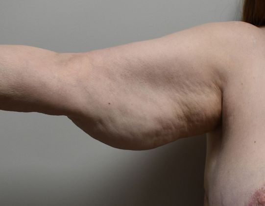 Brachioplasty Case 13 - Before