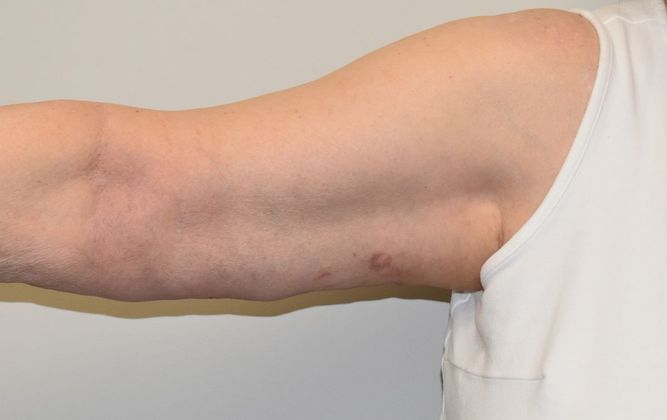 Brachioplasty Case 13 - After