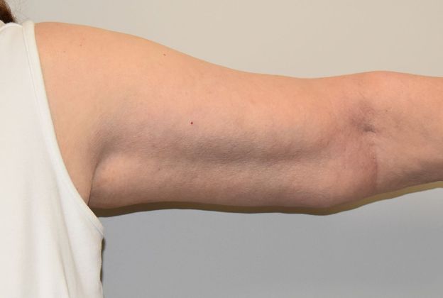 Brachioplasty: Case 13 - After