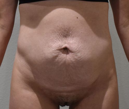 Tummy Tuck (Abdominoplasty): Case 252 - Before