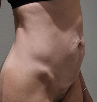 Tummy Tuck (Abdominoplasty): Case 252 - Before