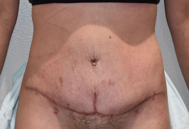 Tummy Tuck (Abdominoplasty): Case 252 - After