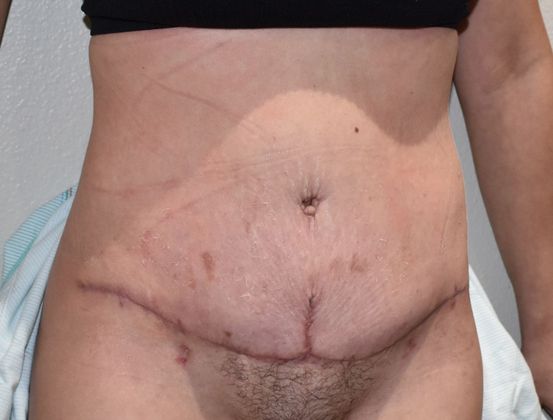 Tummy Tuck (Abdominoplasty): Case 252 - After