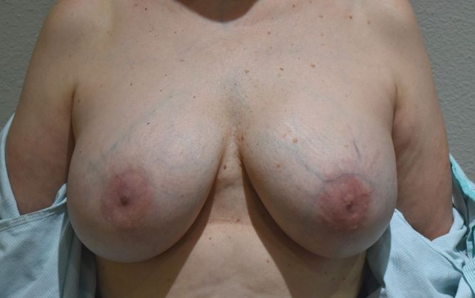 Breast Implant Removal: Case 5 - Before