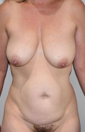 Mommy Makeover Case 173 - Before