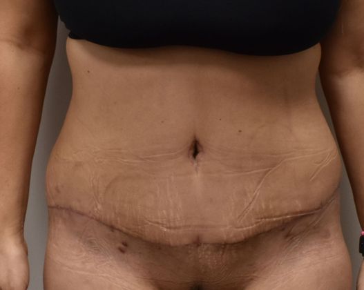 Tummy Tuck (Abdominoplasty): Case 255 - After