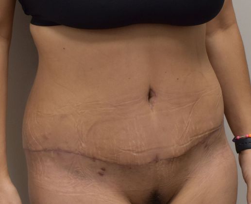 Tummy Tuck (Abdominoplasty): Case 255 - After