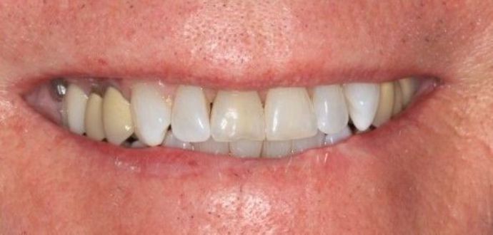 Porcelain Veneers: Case 9 - Before