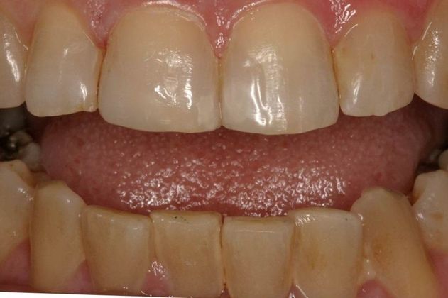 Cosmetic Bonding: Ruth - After