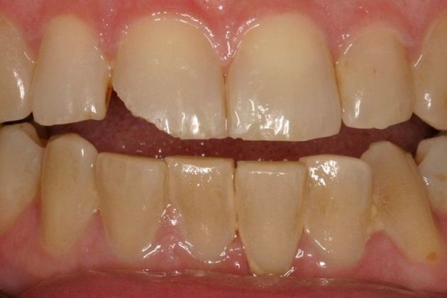 Cosmetic Bonding: Ruth - Before