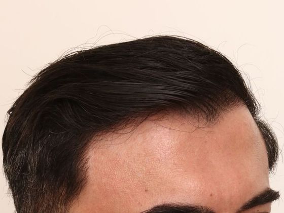 Male Before And After Hair Transplant Photos Hairline FUE (4) - After
