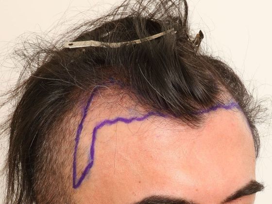 Male Before And After Hair Transplant Photos Hairline FUE (4) - Before