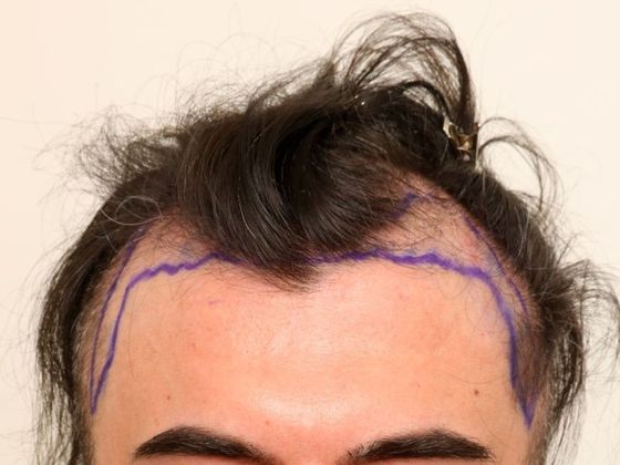 Hair Transplant - Male: Hairline FUE - Case 4 - Before FUE hair transplant