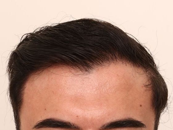 Hair Transplant - Male: Hairline FUE - Case 4 - After FUE hair transplant