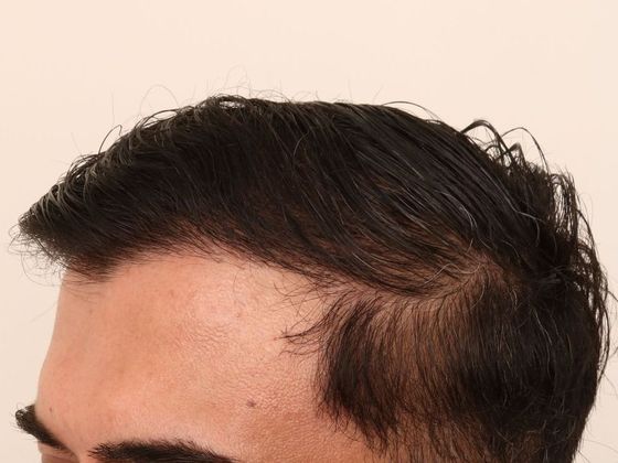 Hair Transplant - Male: Hairline FUE - Case 4 - After FUE hair transplant