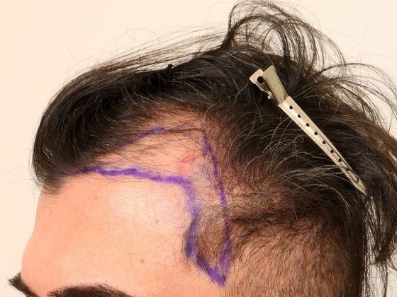 Hair Transplant - Male: Hairline FUE - Case 4 - Before FUE hair transplant