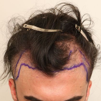 Hair Transplant - Male: Hairline FUE - Case 4 - Before FUE hair transplant