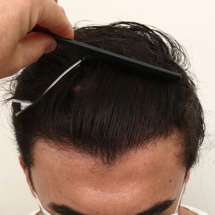 Hair Transplant - Male: Hairline FUE - Case 4 - After FUE hair transplant