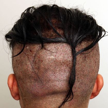 Hair Transplant - Male: Hairline FUE - Case 4 - Post-op FUE hair transplant