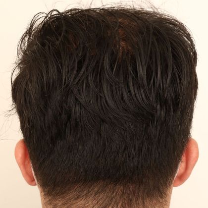 Hair Transplant - Male: Hairline FUE - Case 4 - Donor healed after FUE