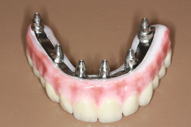 Implant Supported Prosthetics: Case 1 - Before