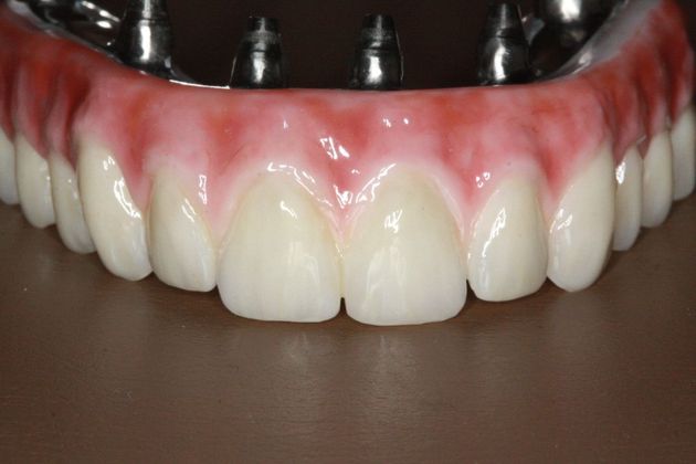 Implant Supported Prosthetics: Case 1 - After