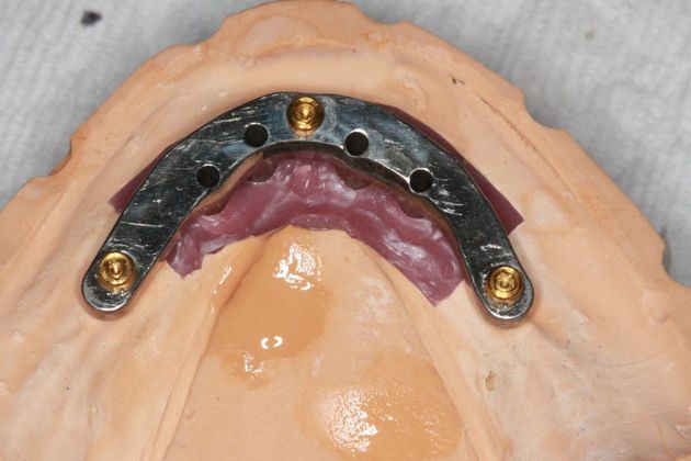 Implant Supported Prosthetics: Case 1 - Before