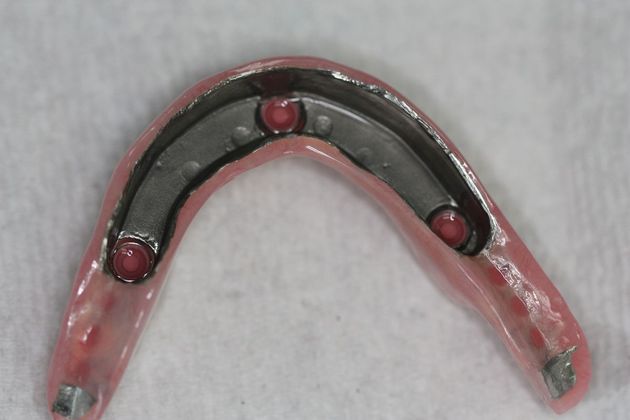 Implant Supported Prosthetics: Case 1 - After