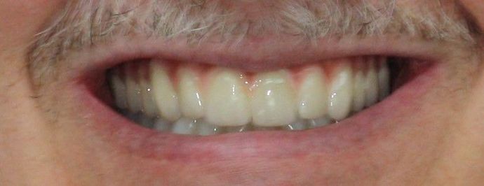 Implant Supported Prosthetics Case 1 - After