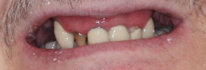 Implant Supported Prosthetics Case 1 - Before