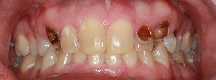Implant Supported Prosthetics Case 2 - Before