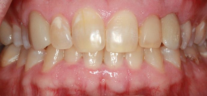 Implant Supported Prosthetics Case 2 - After