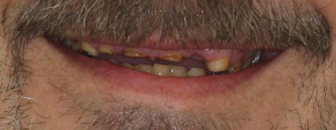 Implant Supported Prosthetics: Case 3 - Before
