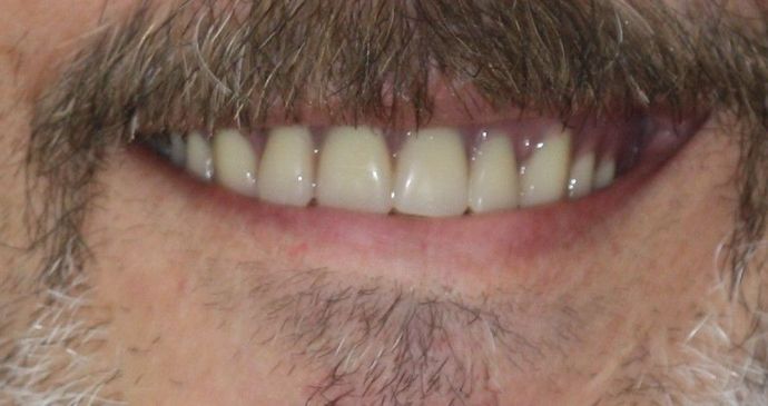 Implant Supported Prosthetics: Case 3 - After