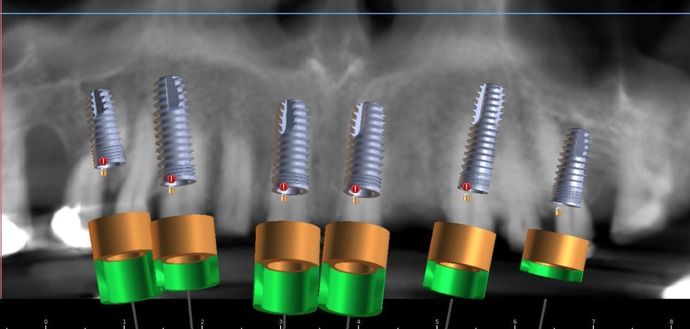 Implant Supported Prosthetics: Case 3 - Before