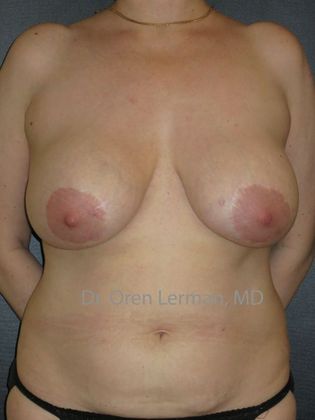 DIEP Flap (natural tissue) Breast Reconstruction Case 7 - DEIP flap (natural tissue) breast reconstruction after breast implant removal and double mastectomy - Before