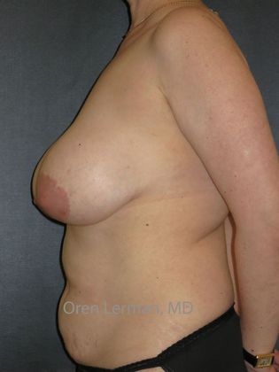 DIEP Flap (natural tissue) Breast Reconstruction: Case 7 - DEIP flap (natural tissue) breast reconstruction after breast implant removal and double mastectomy - Before