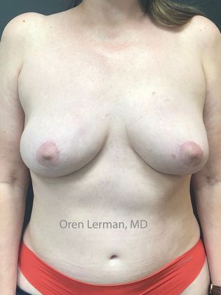 DIEP Flap (natural tissue) Breast Reconstruction Case 7 - DEIP flap (natural tissue) breast reconstruction after breast implant removal and double mastectomy - After