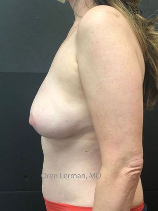 DIEP Flap (natural tissue) Breast Reconstruction: Case 7 - DEIP flap (natural tissue) breast reconstruction after breast implant removal and double mastectomy - After
