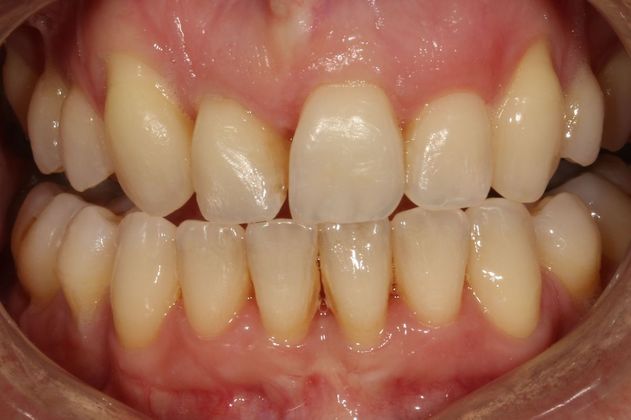 Veneers Case 4 - Before